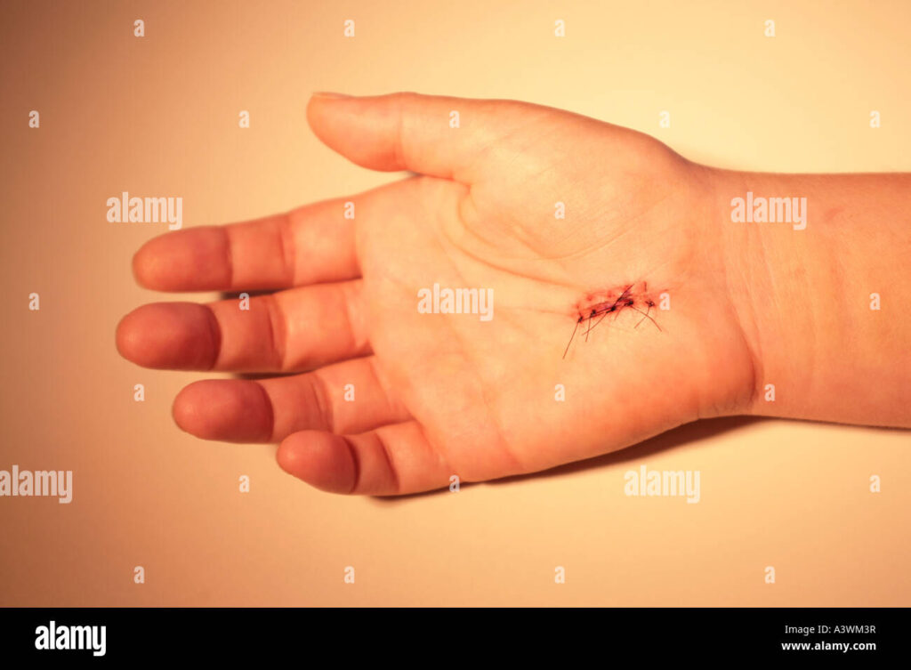 A Complete Guide to Carpal Tunnel Surgery NZ and Recovery Expectations